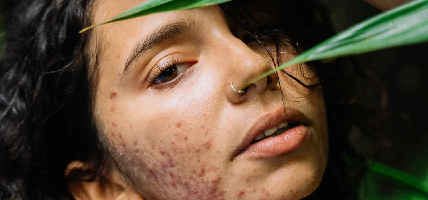 Acne Treatment Newport Beach