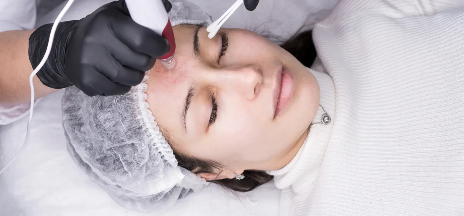 Microneedling Newport Beach