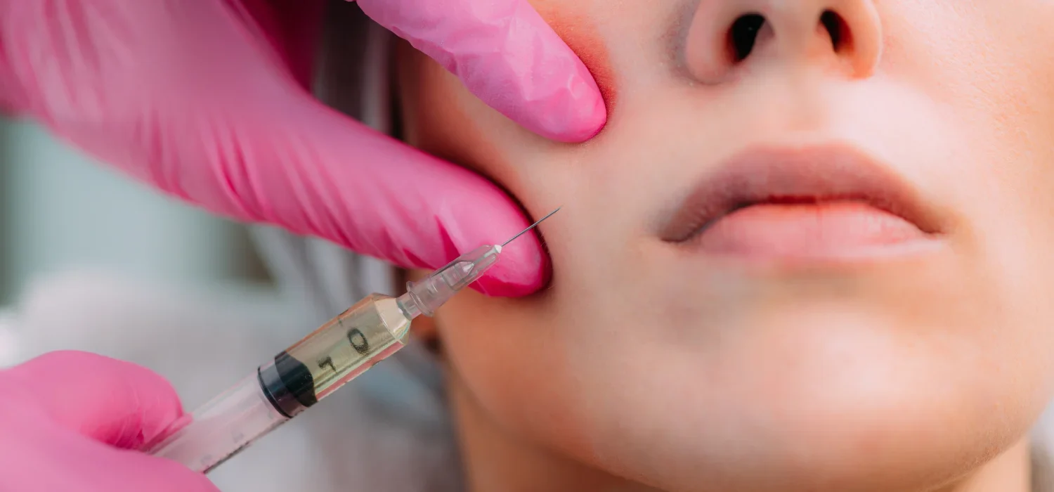 Restylane Kysse Newport Beach