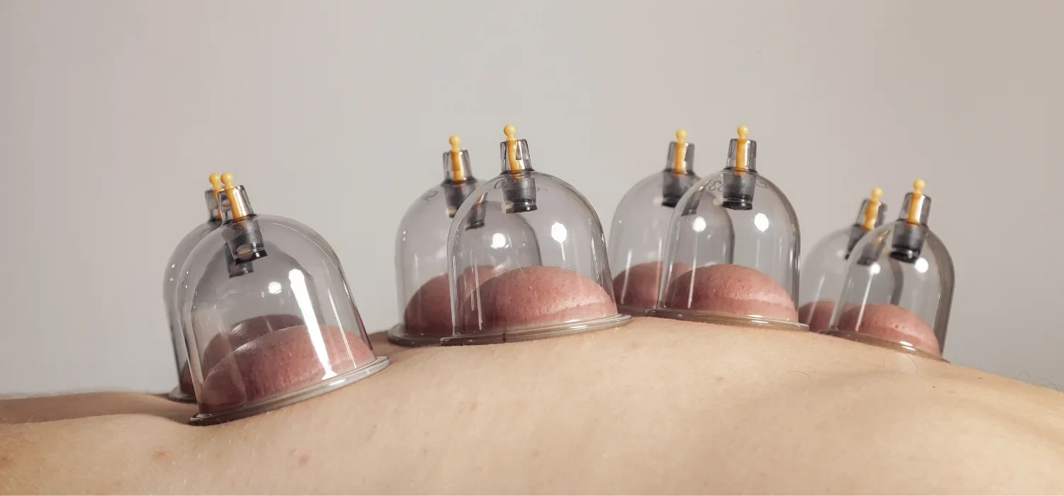 Cupping Therapy Newport Beach
