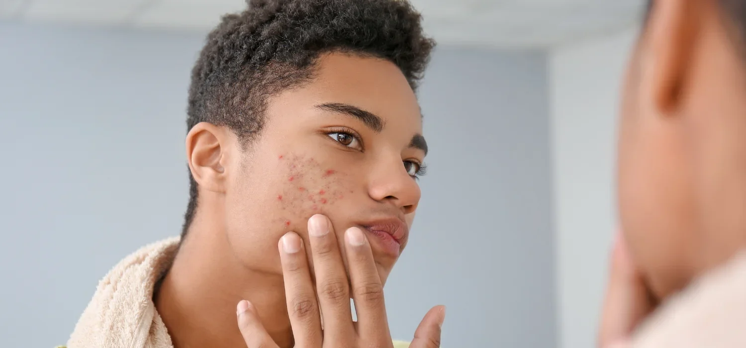 Acne Specialist in Newport Beach
