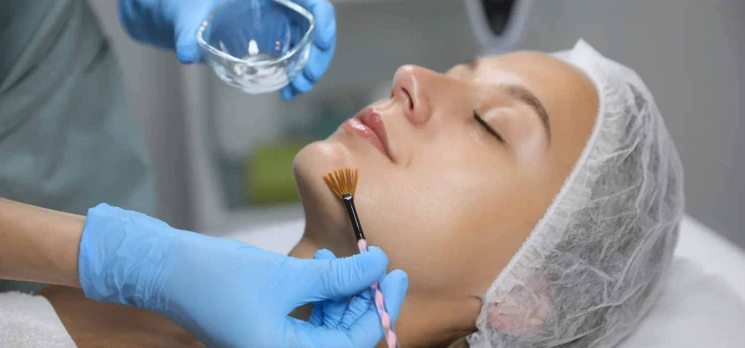 Newport Beach Chemical Peels