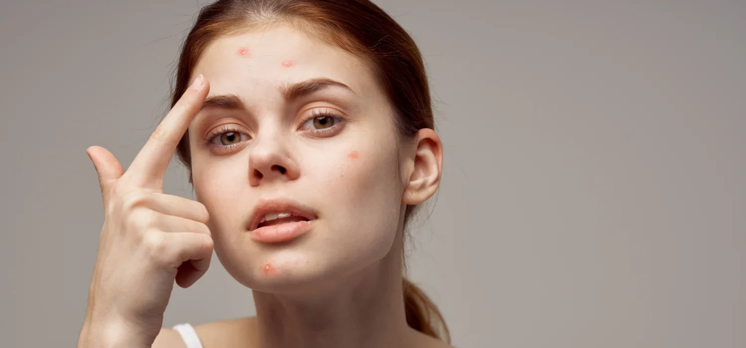 Acne Specialist in Newport Beach