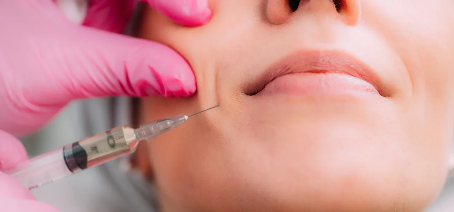 Restylane Kysse in Newport Beach