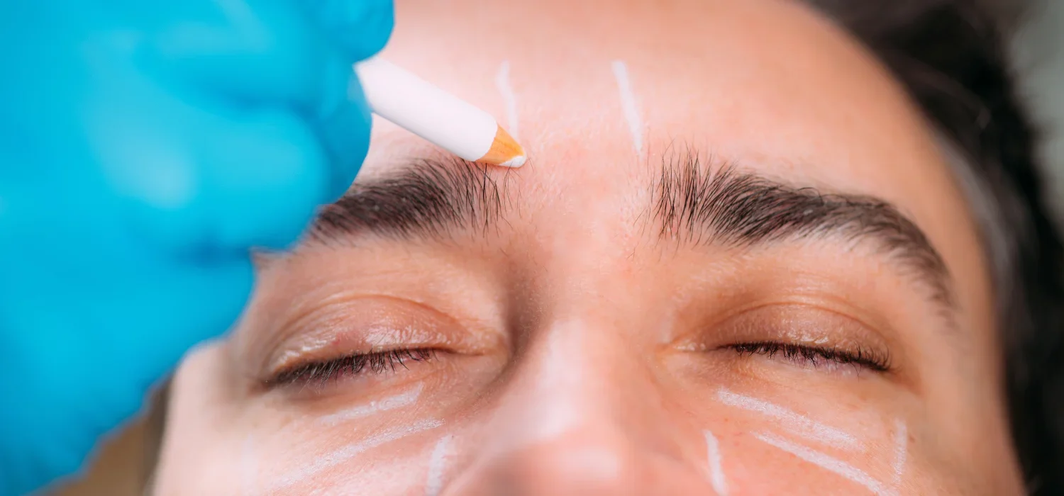 Restylane Kysse in Newport Beach